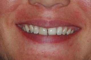 bad porcelain crowns (caps) before two new porcelain crowns