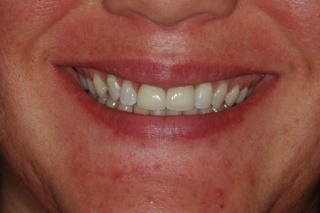 two new porcelain crowns