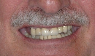 unsatisfied with the asymmetry of the crowns (caps)