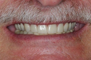 esthetic dentures replaced bad caps