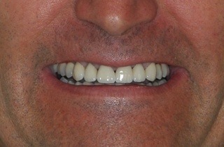 Dental implants, porcelain crowns (caps), and fixed porcelain bridges