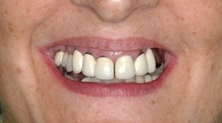 large, white, un-esthetic crowns (caps)