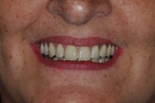 6 dental implants transformed her smile and provided her with a full set of upper teeth